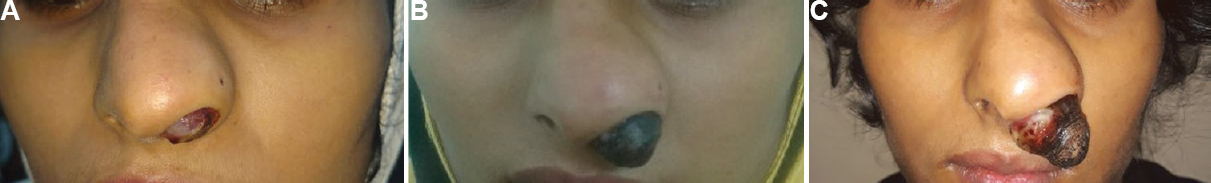 (A) Widening of vestibule with firm nasal mass protruding from the left nostril covered with mucoid discharge on day 3 of presentation.(B) Nasal mass with externally exposed part showing necrosis and crusting on day 9 of presentation. (C) Increase in size of mass with crusting and necrosis on day 14 of presentation.